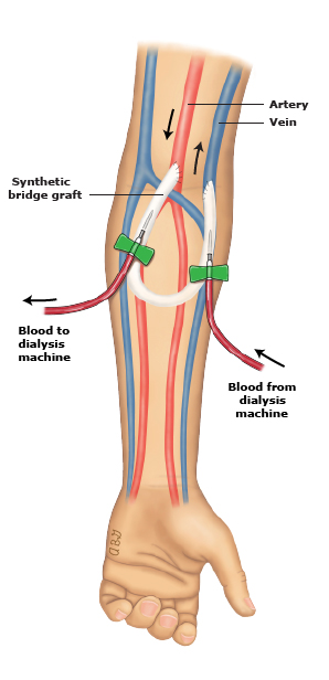 AV grafts — a synthetic tube connecting artery and vein